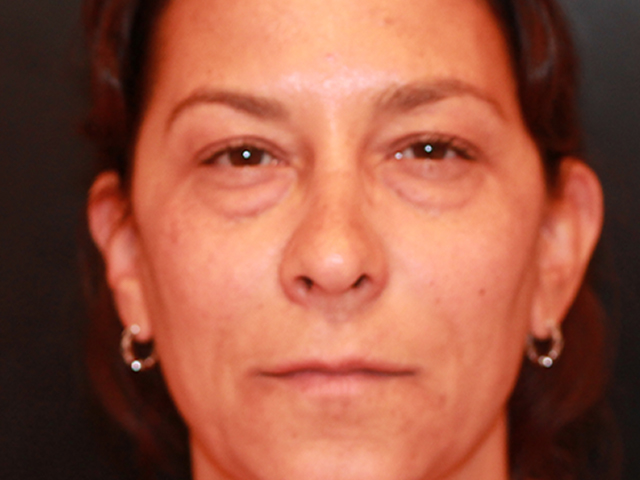 blepharoplasty patient