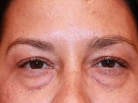 blepharoplasty patient