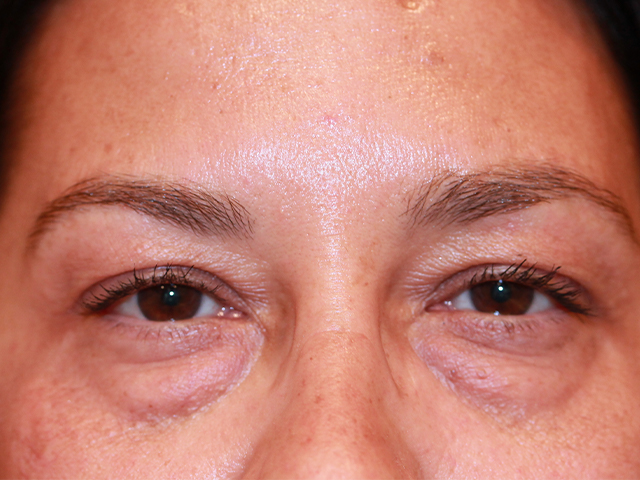 blepharoplasty patient