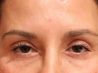 blepharoplasty patient