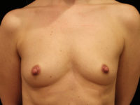 breast augmentation patient