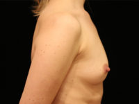 breast augmentation patient