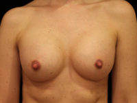 breast augmentation patient