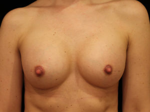 breast augmentation patient