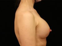 breast augmentation patient