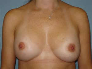 breast augmentation patient