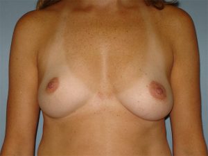 breast augmentation patient