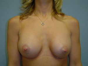 breast augmentation patient