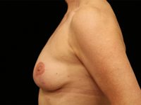 breast lift patient