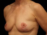 breast lift patient