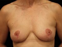 breast lift patient
