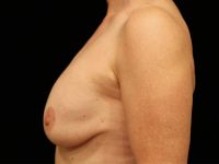 breast lift patient