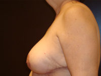 breast reduction patient
