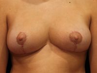 breast reduction patient