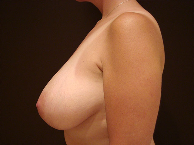 breast reduction patient
