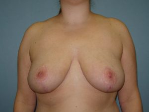 breast reduction patient