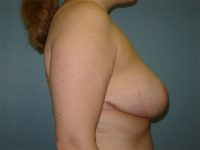 breast reduction patient