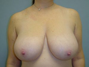 breast reduction patient