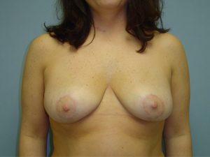 breast reduction patient