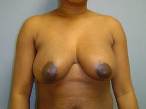 breast reduction patient