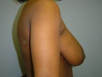 breast reduction patient