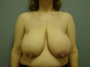 breast reduction patient