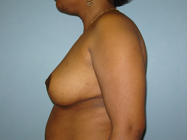 breast reduction patient