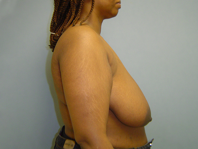 breast reduction patient