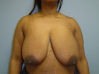 breast reduction patient