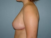 breast reduction patient