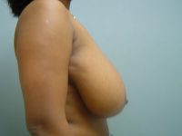 breast reduction patient