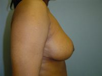 breast reduction patient