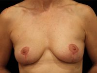 breast revision patient
