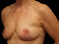breast revision patient