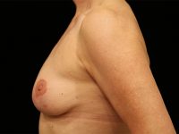 breast revision patient