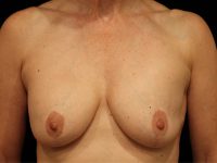 breast revision patient