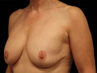 breast revision patient