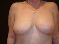 breast revision patient