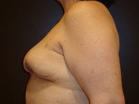 breast revision patient