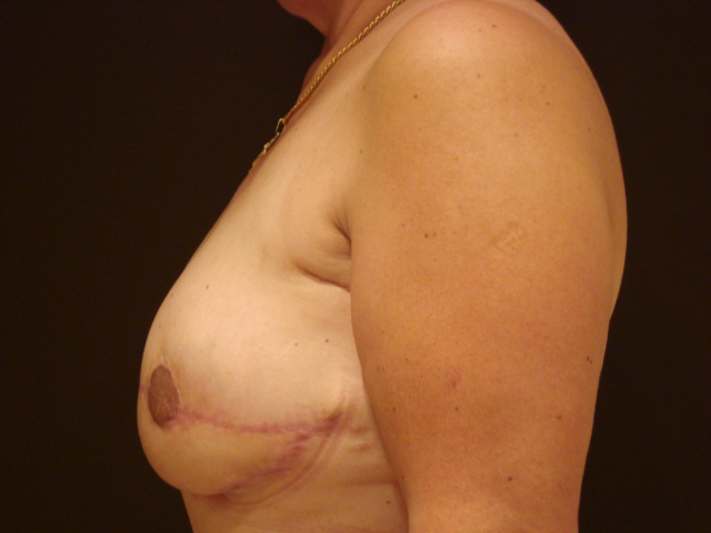 breast revision patient