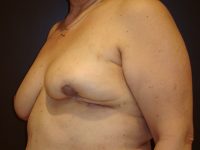 breast revision patient