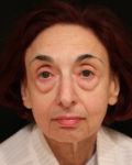 facelift patient