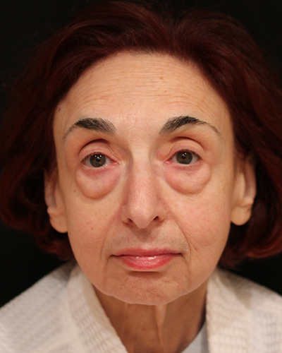facelift patient