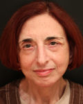 facelift patient