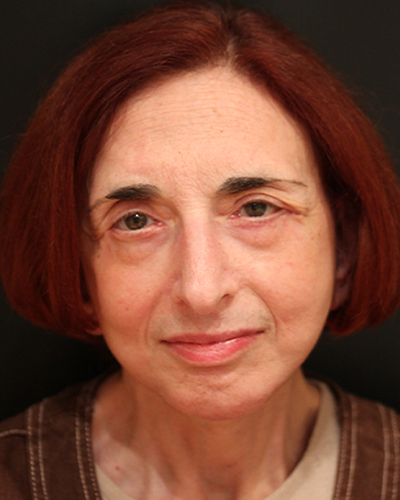 facelift patient