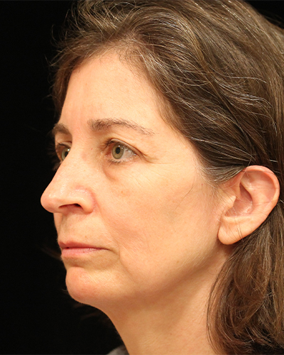 facelift patient