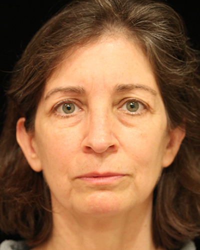 facelift patient