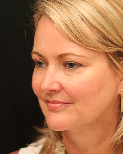 facelift patient