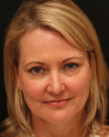 facelift patient