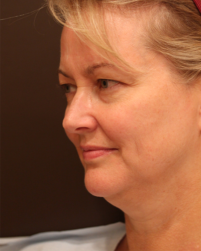 facelift patient